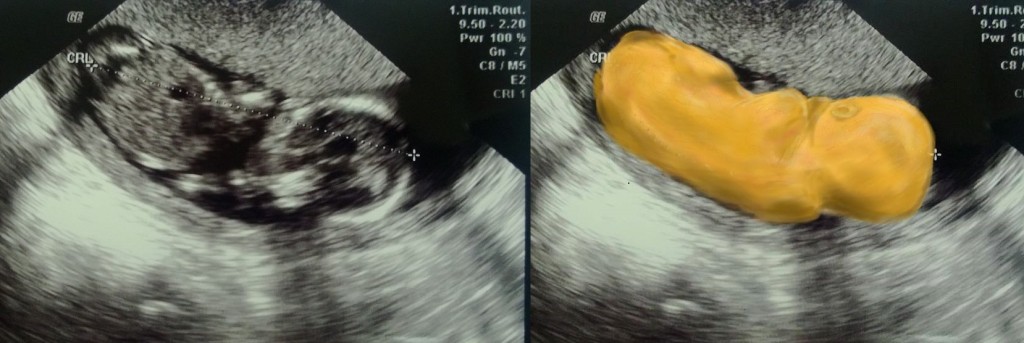 colored baby sonogram